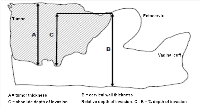 Assessing stromal infiltration
