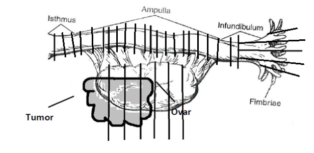 Komplette Aufarbeitung von Ovar in Querschnitten und Tube nach speziellem Protokoll: Sectioning and Extensively Examining the FIMbria (SEE-FIM).