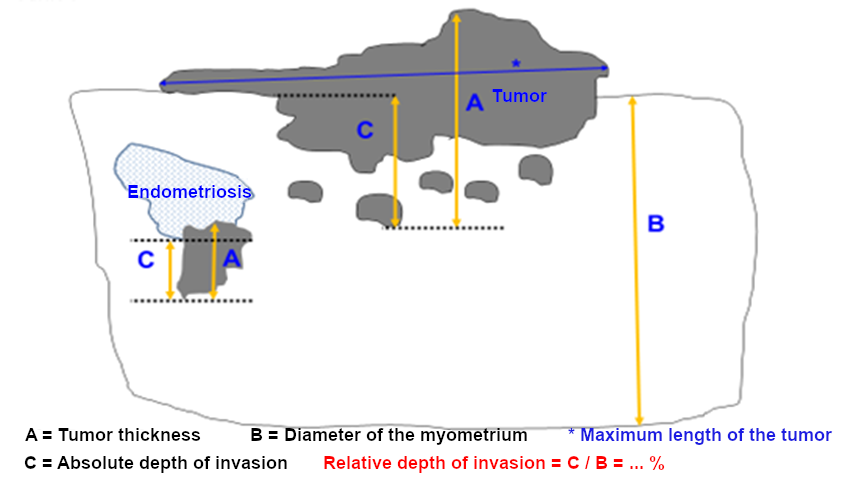 Measurement of depth of invasion in endometrial carcinoma