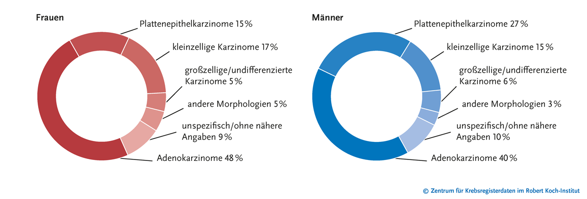 Verteilung der bösartigen Neubildungen der Lunge nach histologischem Typ und Geschlecht (In Prozent), ICD-10 C33-C34, Deutschland 2017-2018, Quelle: Zentrum für Krebsregisterdaten im Robert Koch Institut
