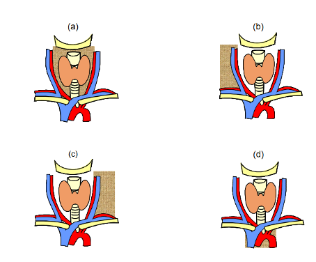 Kompartmentklassifikation der lokoregionären Lymphknoten beim Schilddrüsenkarzinom (Dralle 2012). (a) Zentrales (K1a, rechts; K1b, links), (b) rechts-zervikolaterales (K2), (c) links-zervikolaterales (K3), und (d) infrabrachiocephales Kompartment des oberen Mediastinums (K4a, rechts; K4b, links).