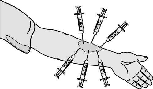 Applikation von Hyaluronidase durch periläsionale Injektionen